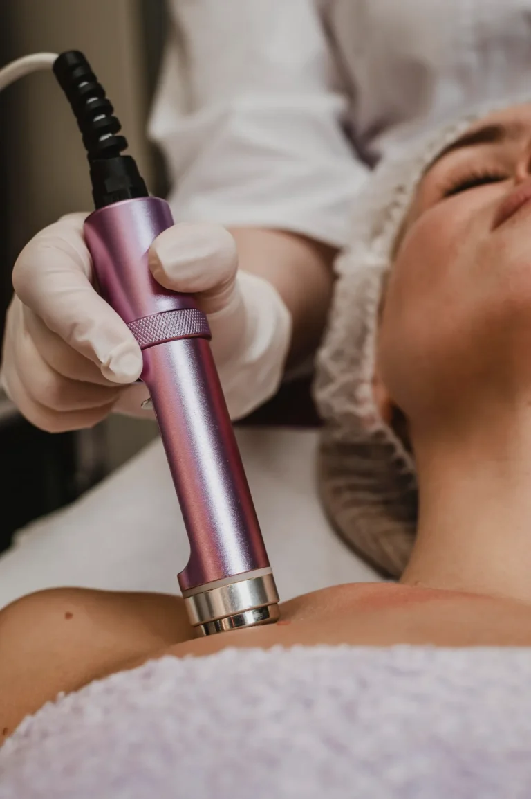 Dermatologist performing microneedling treatment on stretch marks to improve skin texture and appearance.