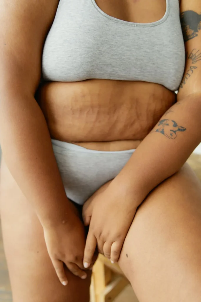Red stretch marks on skin illustrating different stages commonly treated with microneedling.