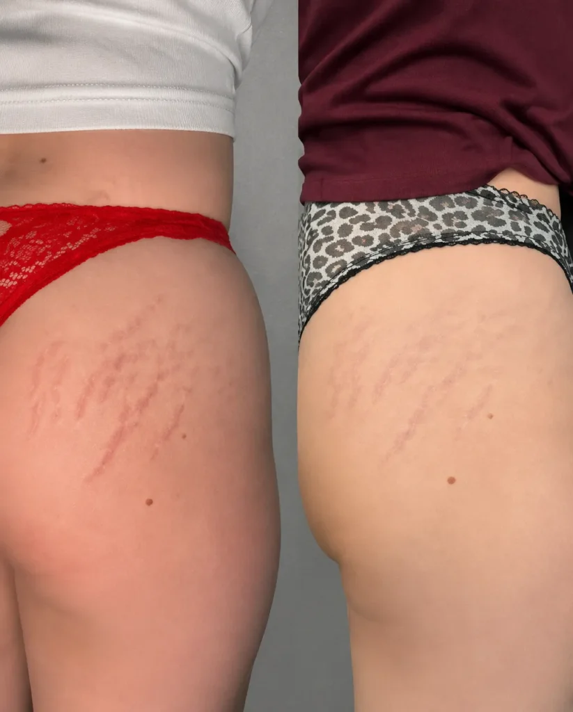Close-up comparison showing improvement in stretch marks after multiple microneedling sessions.