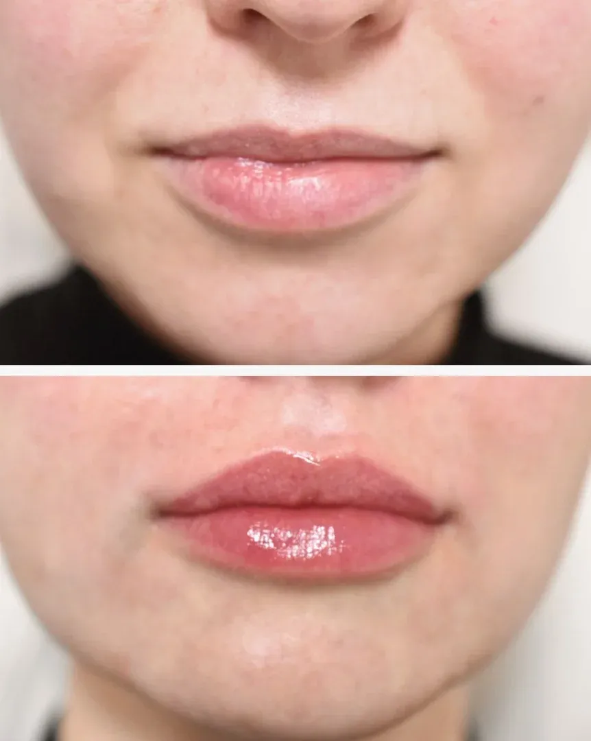 Neauvia dermal filler treatments in London