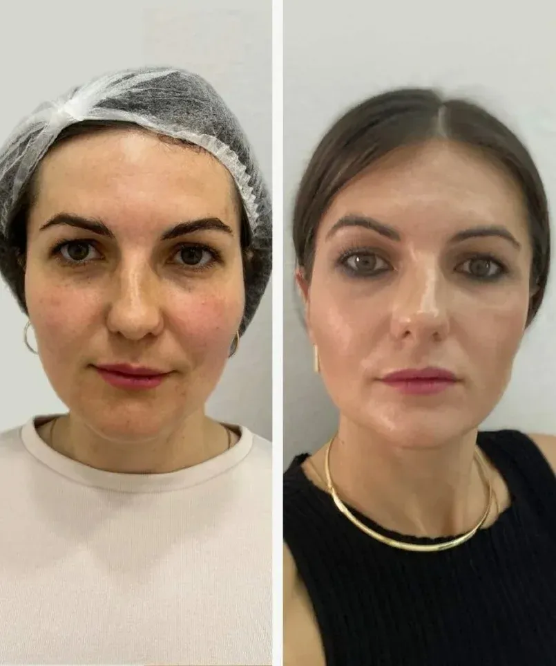 Before and after temple fillers