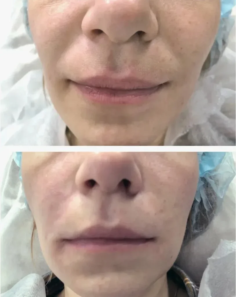 What is Neauvia filler treatment