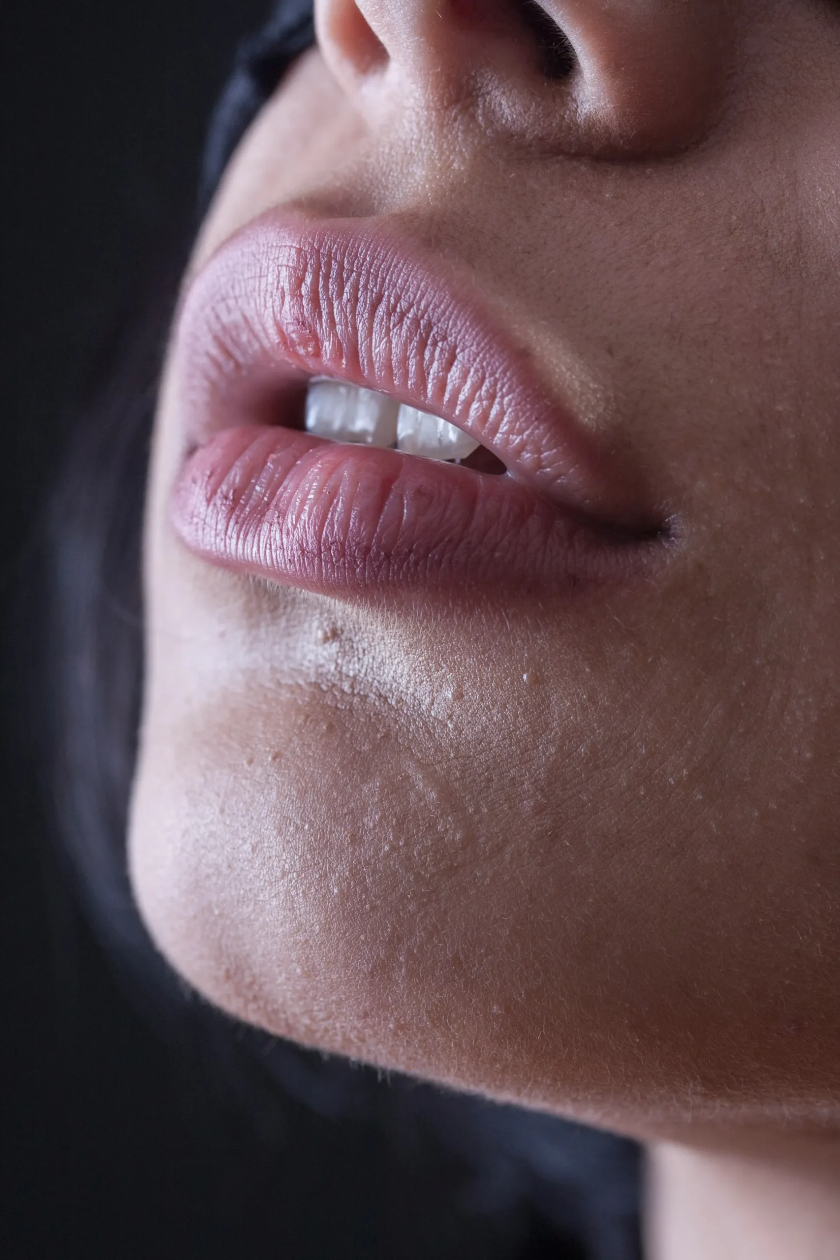 Woman with full lips after aesthetic beauty treatment