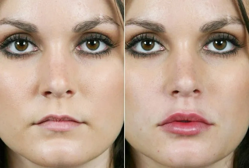 Woman showing natural lip enhancement results after Juvederm filler treatment with improved volume and definition