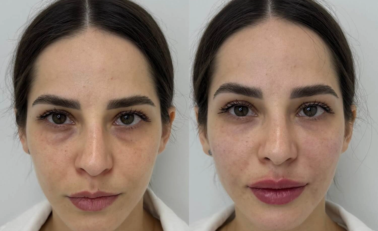 Juvederm hyaluronic acid dermal filler syringe for professional lip enhancement treatment.