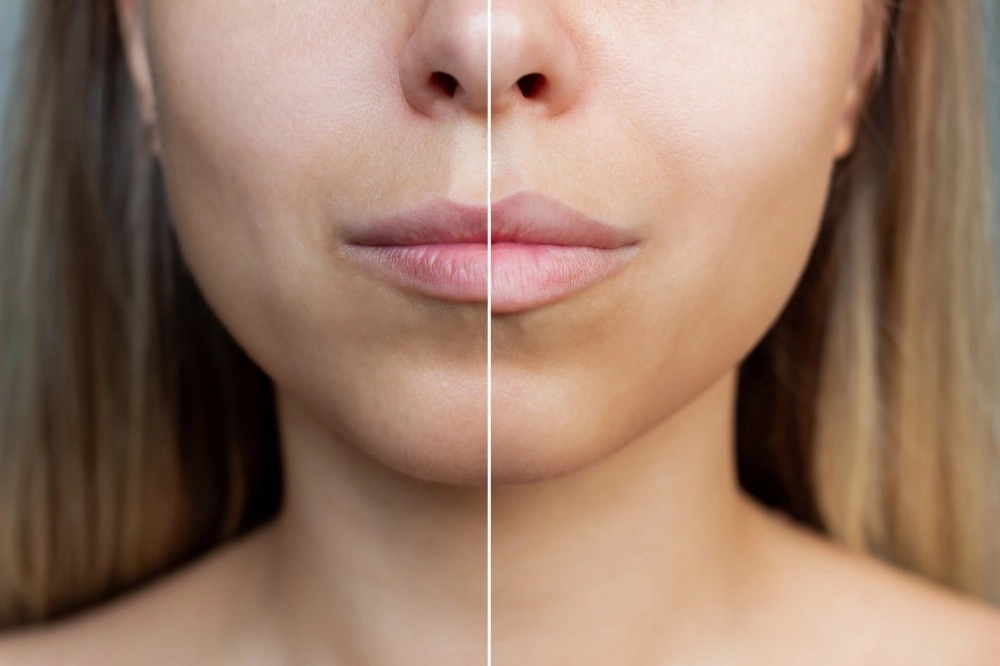Benefits of lip filler.