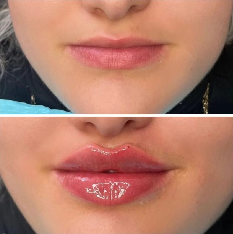 Russian lip filler treatment.