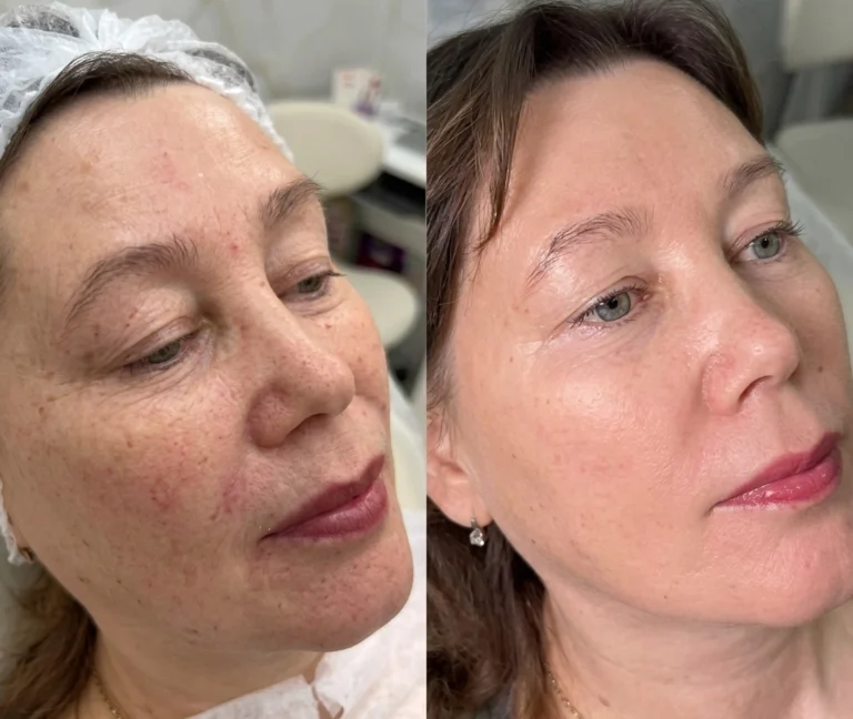 Before and after Salmon DNA Injection with clearer, brighter and smoother face.