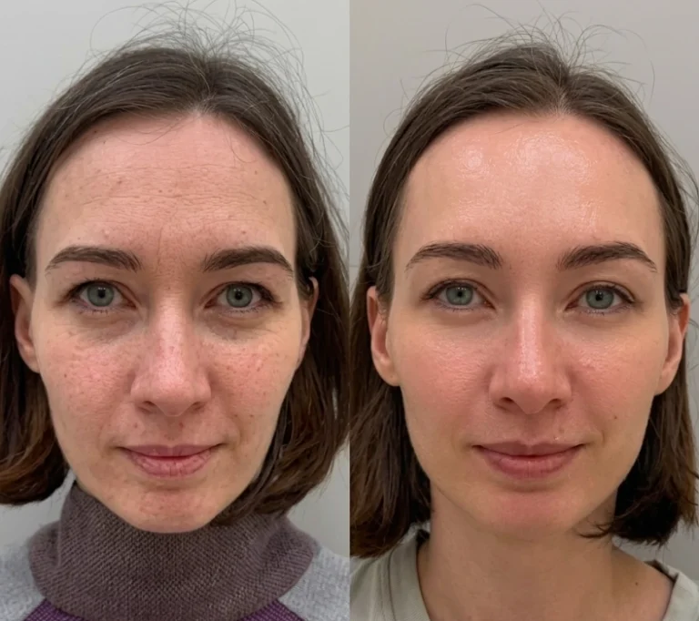 Before and after Salmon DNA Injection with smoother texture and radiant skin.