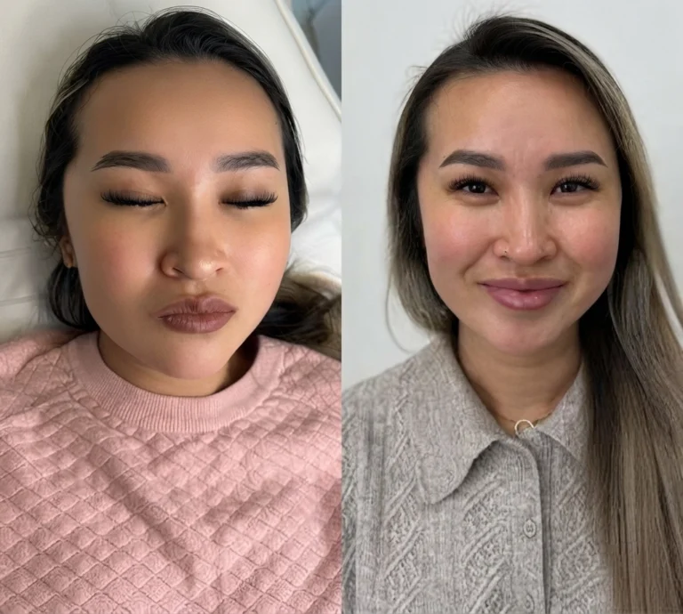 Before and after Salmon DNA Injection with improved tone and smooth texture.