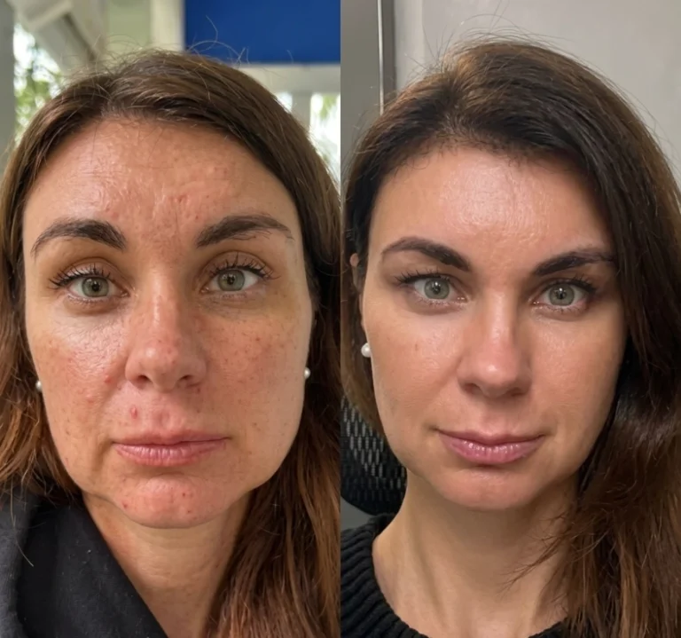 Before and after Salmon DNA Injection with improved tone and smooth texture.