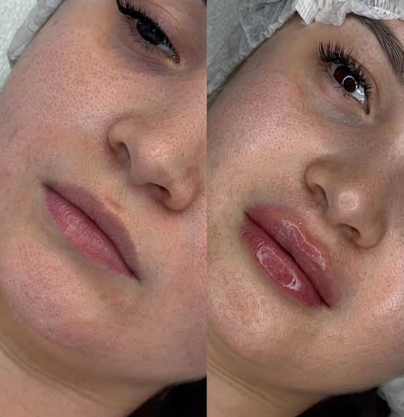 Before and after comparison showing natural thin lips transformation with hyaluronic acid filler treatment.