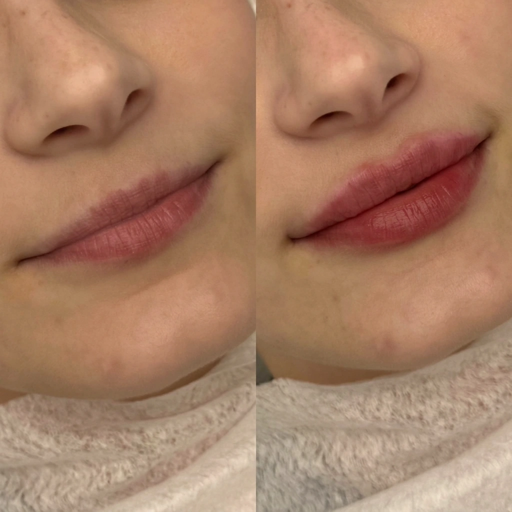 Woman with thin lips explaining hyaluronic acid dermal filler treatment for lip volume enhancement.