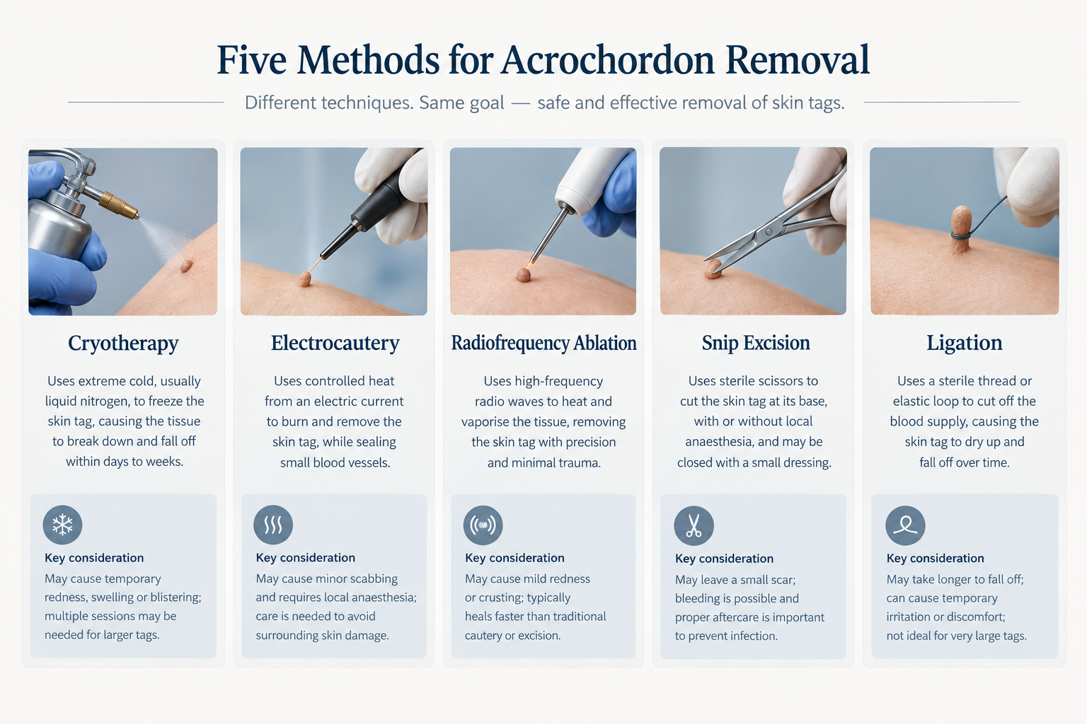 Infographic comparing five clinical acrochordon removal methods including cryotherapy and excision