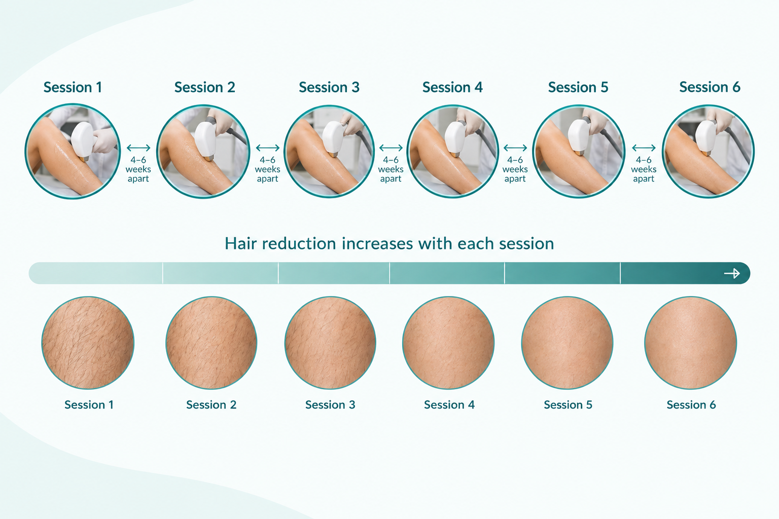 Infographic showing typical session timeline and progressive hair reduction for Brazilian laser