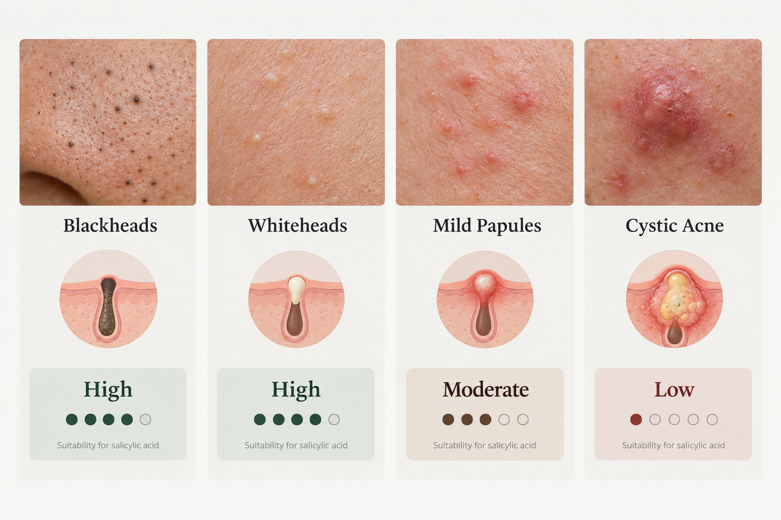 Infographic comparing salicylic acid effectiveness across blackheads, whiteheads, papules and