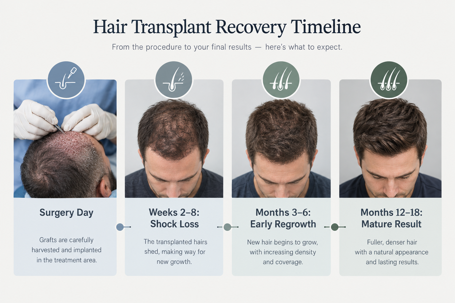 Hair transplant recovery and growth timeline from surgery to mature results at 12 to 18 months