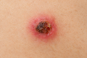 Close-up illustration of an infected mole showing redness and swelling on skin