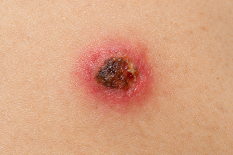 Close-up illustration of an infected mole showing redness and swelling on skin