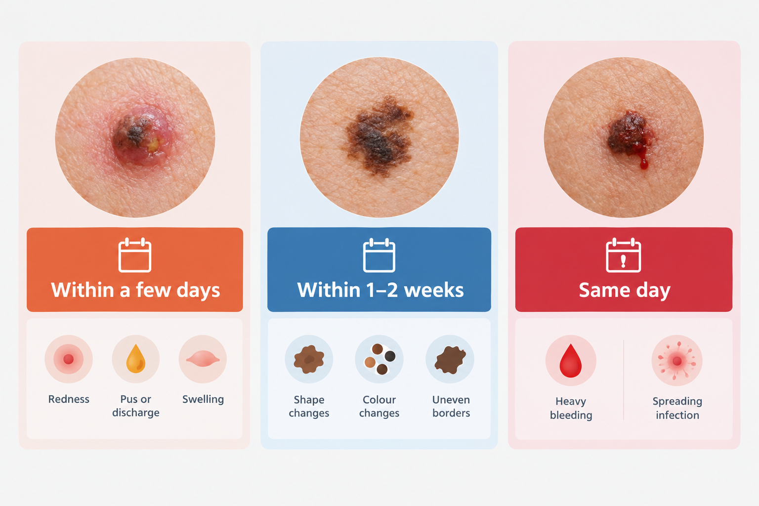 Urgency guide illustration showing when to seek medical assessment for a changing or infected mole