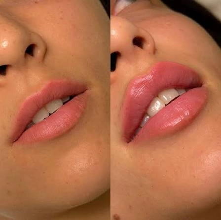 Woman after lip augmentation.