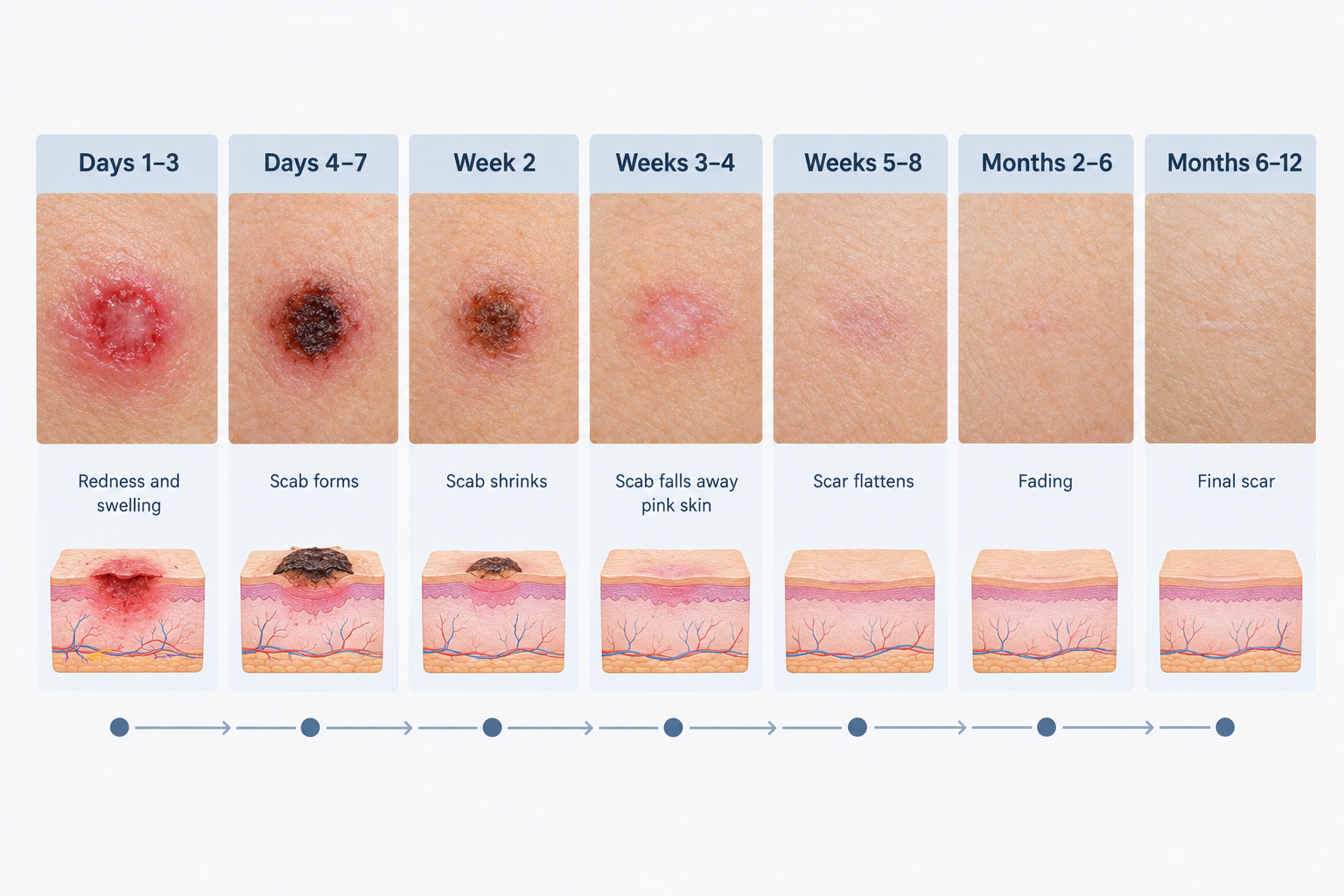 Week-by-week mole removal healing timeline from initial wound through scar maturation