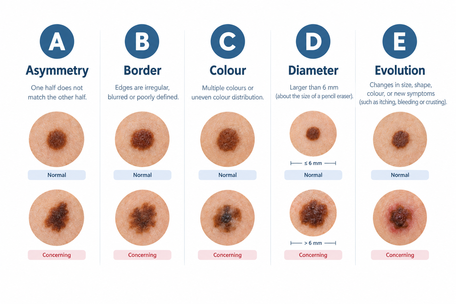 ABCDE criteria infographic for mole self-monitoring showing asymmetry, border, colour, diameter