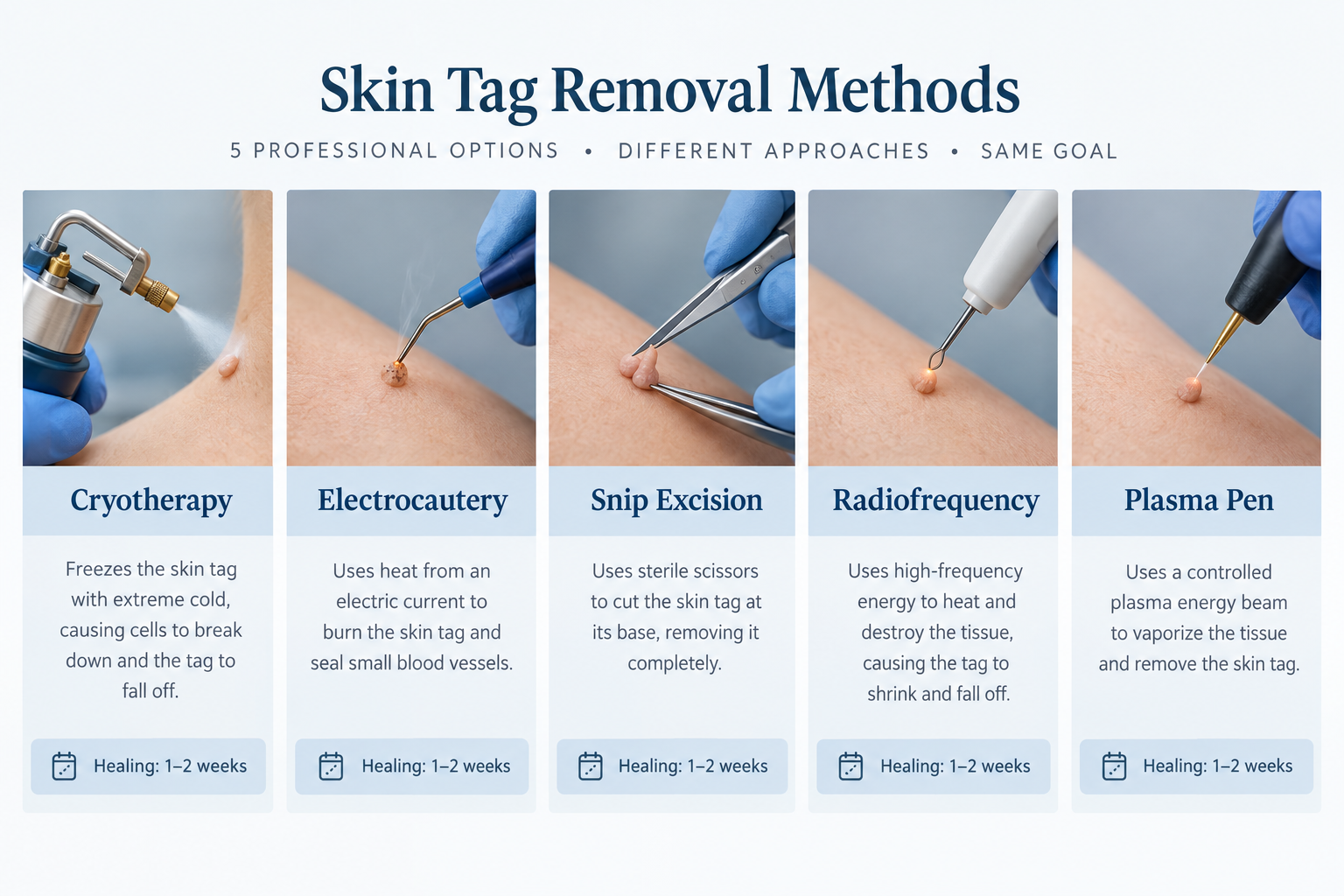 Comparison infographic of professional skin tag removal methods including cryotherapy and