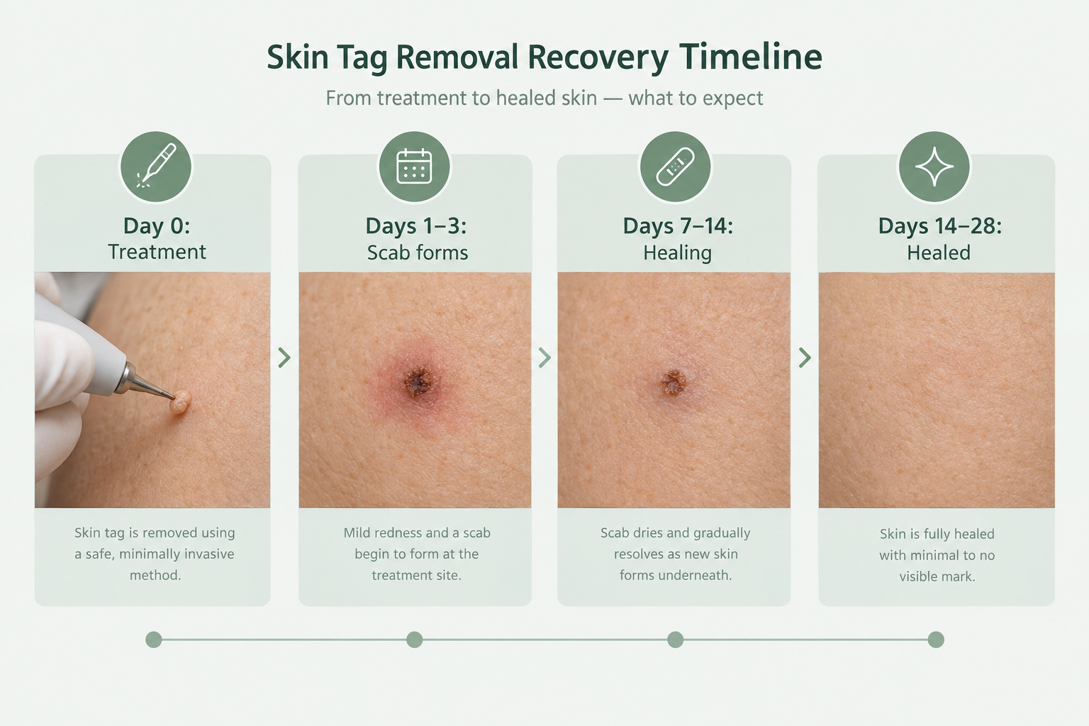 Recovery timeline infographic after professional skin tag removal from treatment day to healed skin