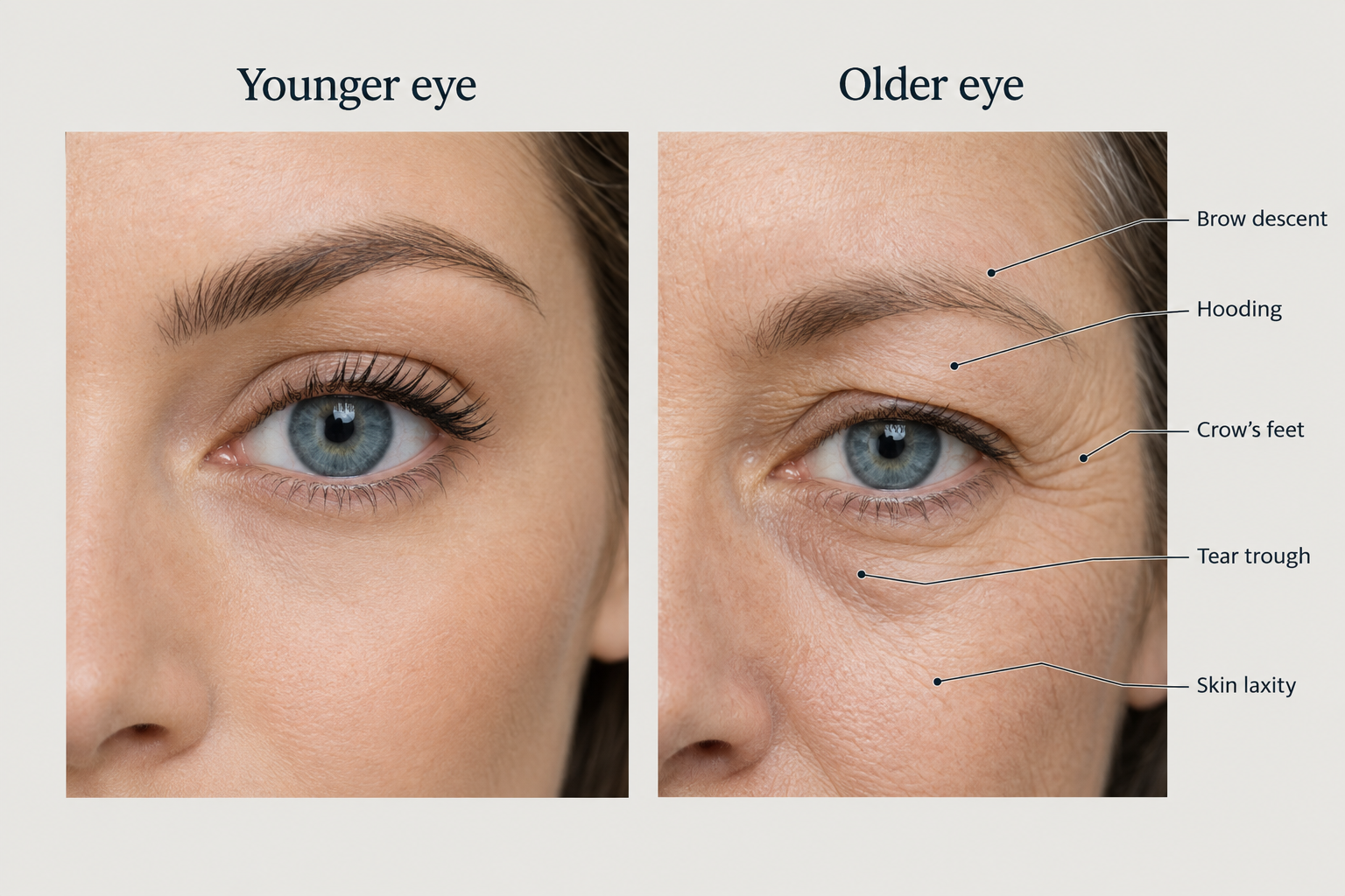 Illustration comparing younger and older eye appearance showing brow descent and hooding with age