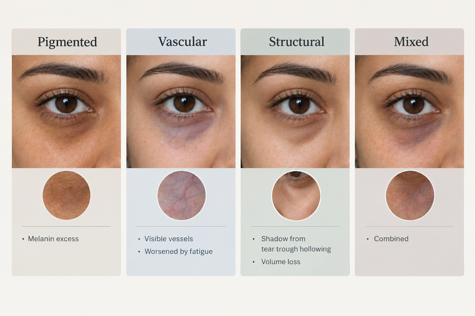 Infographic summarising the four types of dark circles under eyes and their main causes