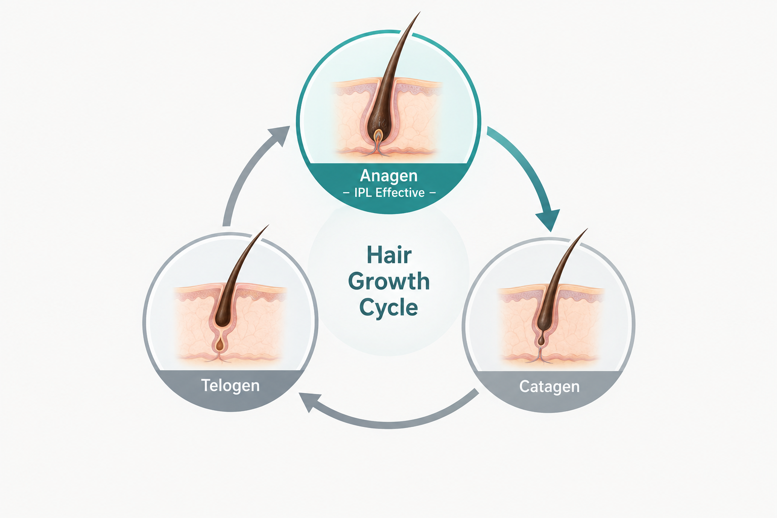 Hair growth cycle diagram showing anagen, catagen and telogen phases relevant to IPL treatment