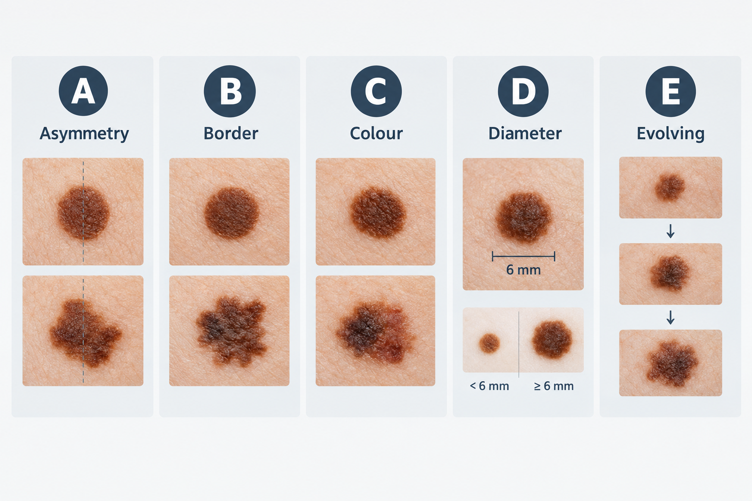 ABCDE mole self-check criteria infographic showing asymmetry, border, colour, diameter and evolving